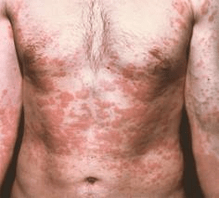 Problematic skin is a symptom of the presence of parasites