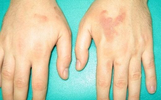 pain in the joints of the hands can be symptoms of parasites